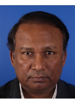 After Hair Transplant&nbsp;Front